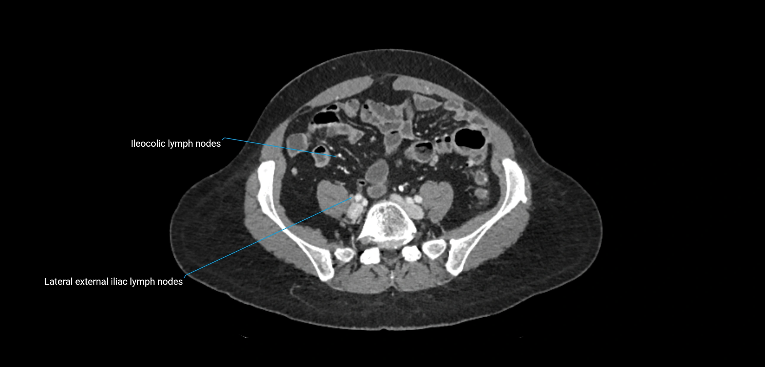 CT ct abdominal lymph nodes  axial cross sectional anatomy  enchanced radiology image -img-00002-00306.webp